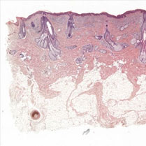 Using microscopy to understand skin fragility disorders